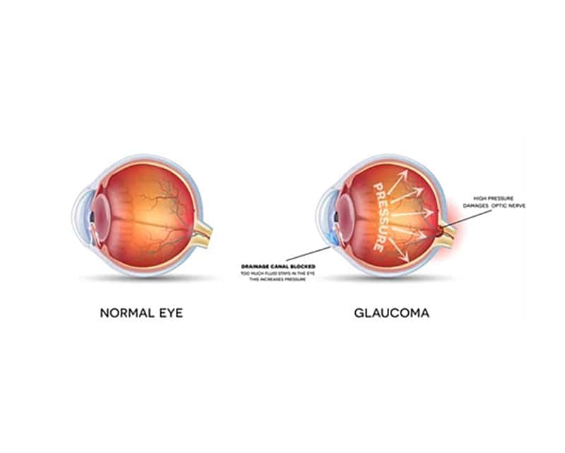 Glaucoma and normal eye.