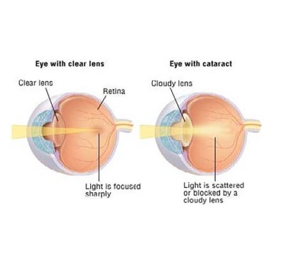 A diagram of an eye with a clear eye and a cloudy eye.